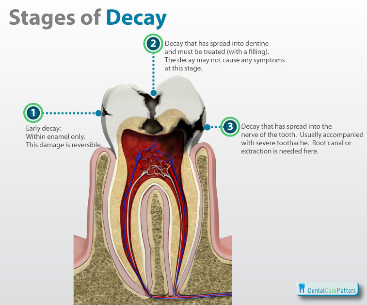 cavity side of molar